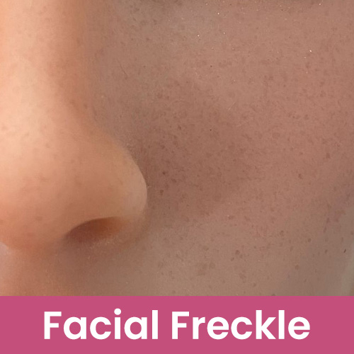Face freckles [+$  55]